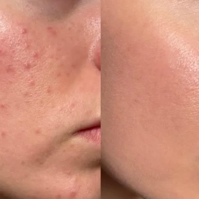 12 week - ACNE BOOTCAMP at Mia Simone Esthetics in Largo, FL